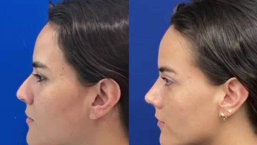 Caso rinoplastia